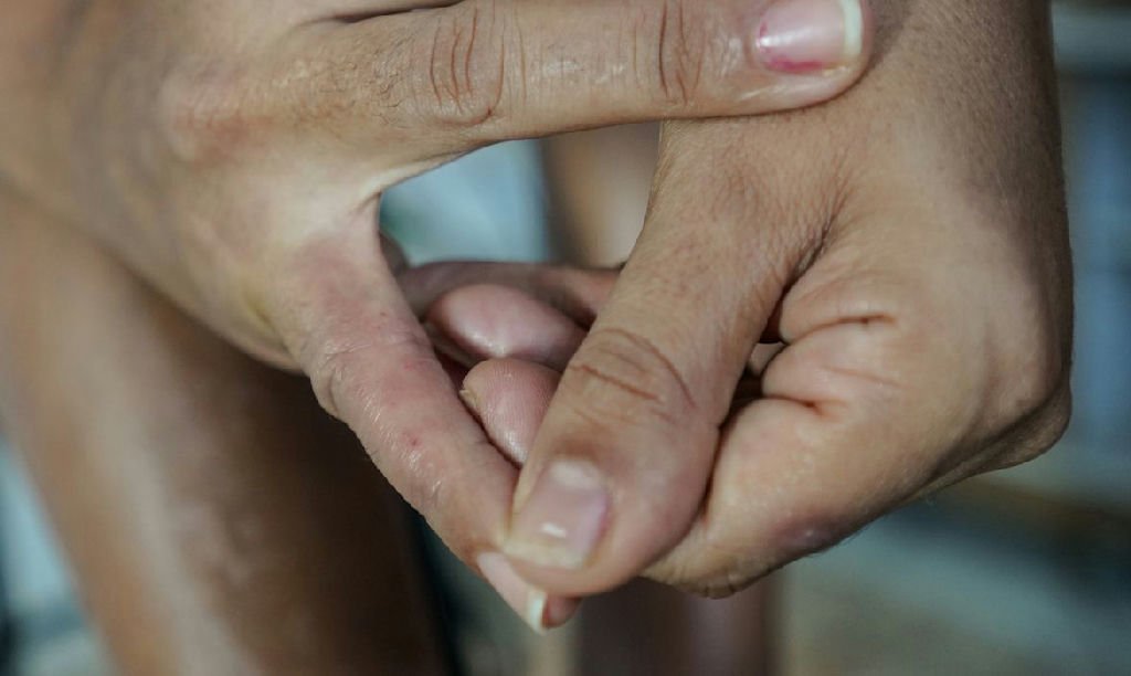Dermatite atópica: a doença que vai além da pele e afeta sono e autoestima