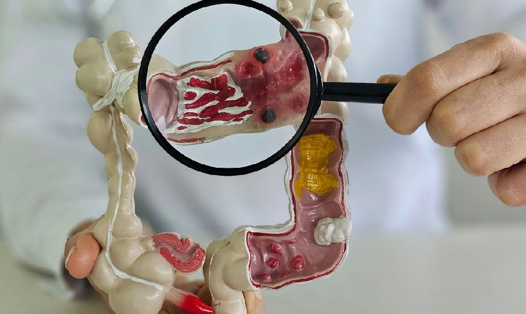 Doenças inflamatórias intestinais disparam no Brasil e preocupam especialistas