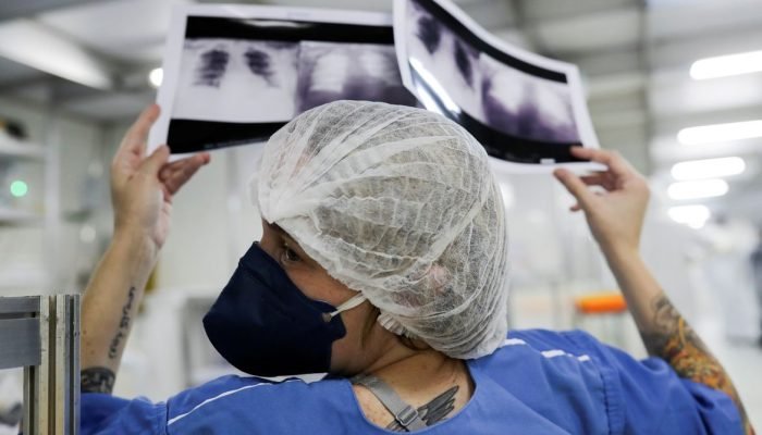 Câncer de pulmão: 90% dos diagnósticos no SUS chegam em fase avançada, alertam especialistas