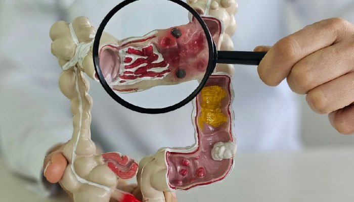 Doenças inflamatórias intestinais disparam no Brasil e preocupam especialistas