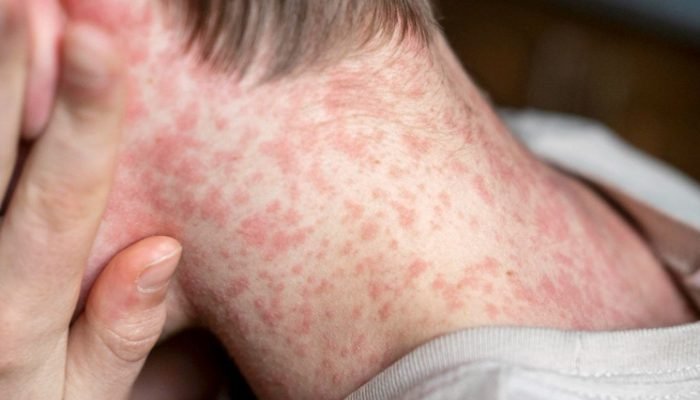 Sarampo em alerta: Brasil reforça vacinação diante de risco de reintrodução da doença